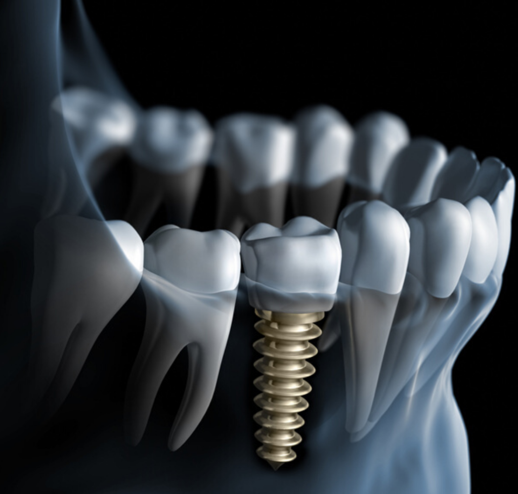 Custom Implant Restorations