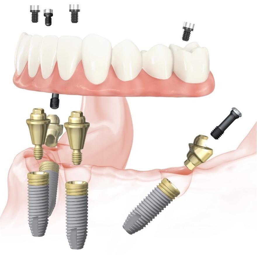 Chair Side Conversions